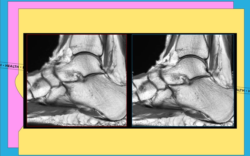 AIR Recon na MRI kotníku